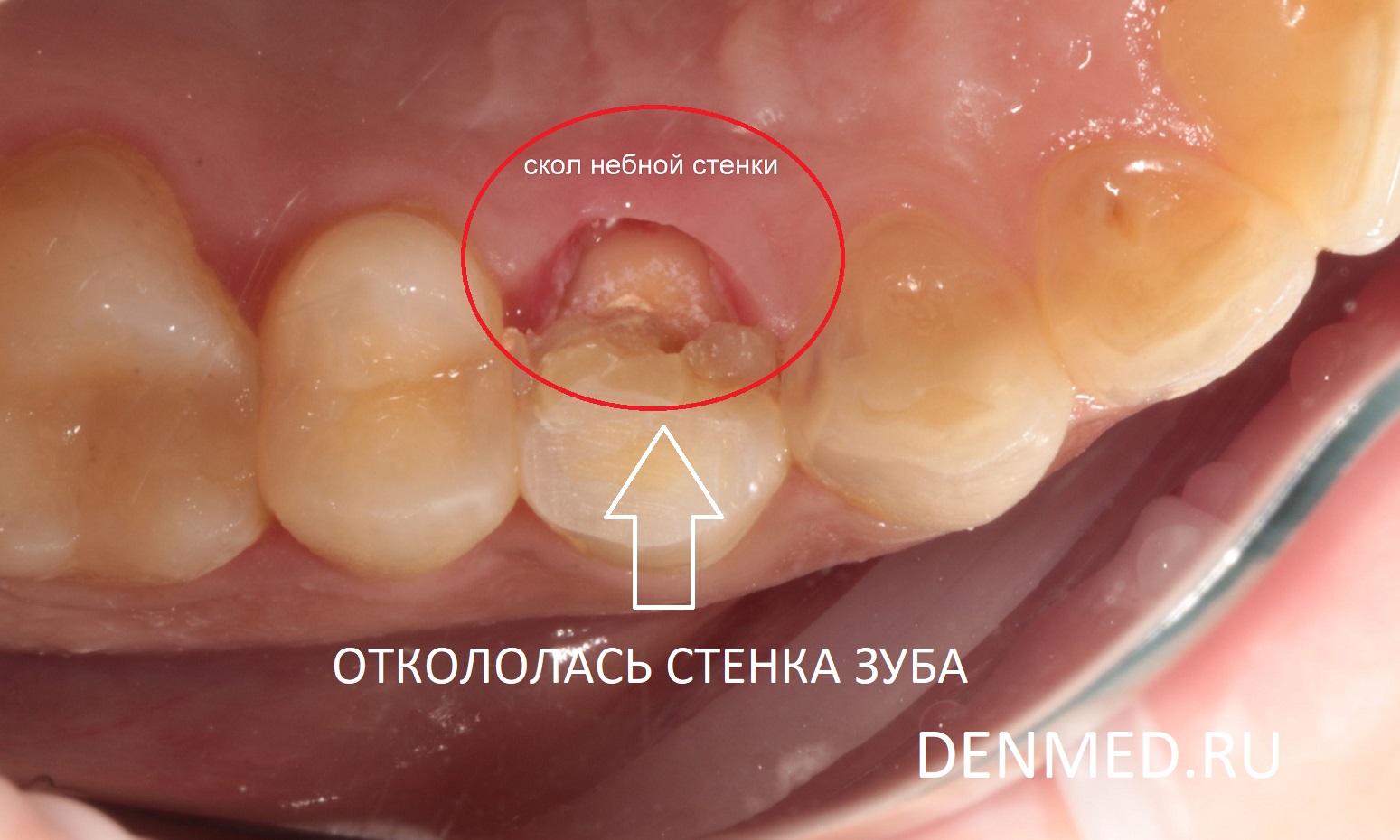 Линия скола зуба прошла глубоко под десной - лечение в клинике ДенМед