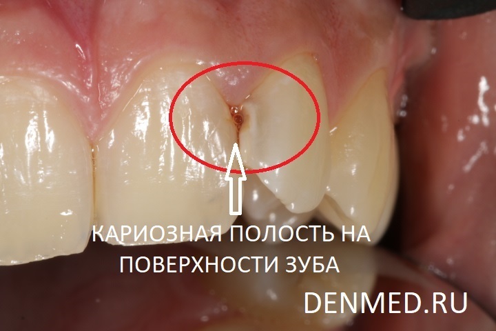 Мы видим кариозную полость прямо на контактной поверхности зуба
