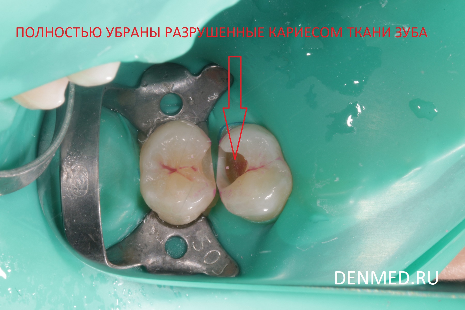 Полностью убраны разрушенные кариесом ткани зуба