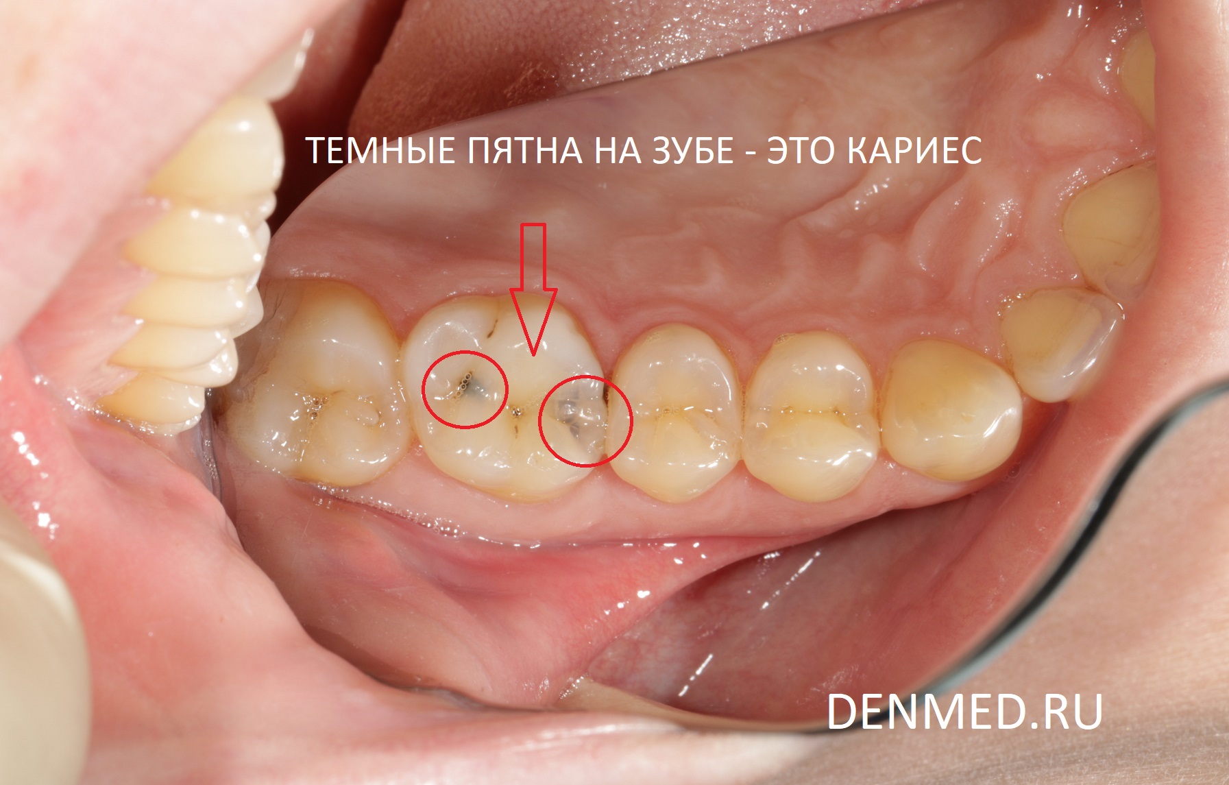 Проблема найдена, вот эти темные пятна на зубе - ничто иное, как тот самый кариес, который возникает от сладкого