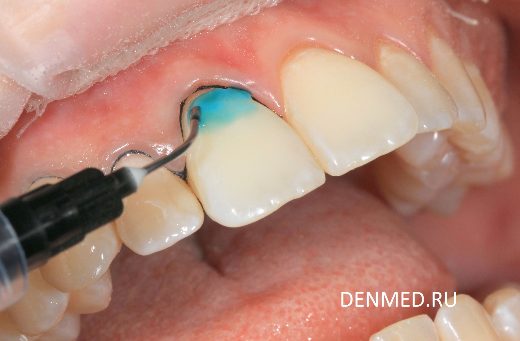 Протравливаем поверхность эмали зубов 36%- ортофосфорной кислотой