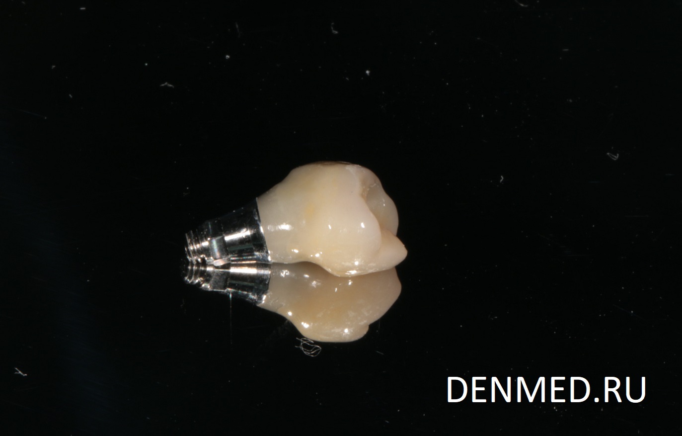 Вид импланта, который сейчас установим на место потерянного зуба