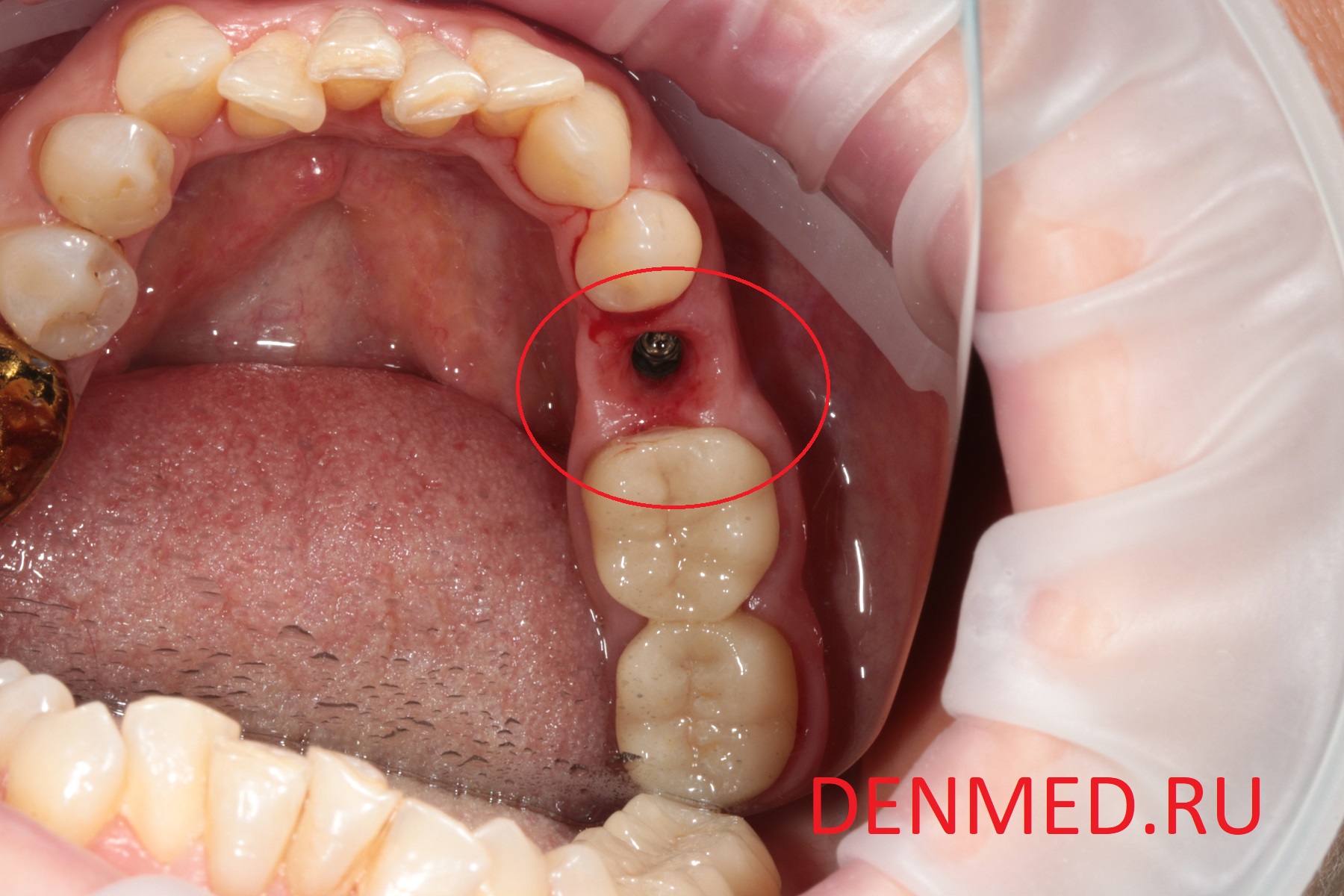 Вид установленного искусственного корня - зубной имплант, который уже готов к фиксации искусственной коронки